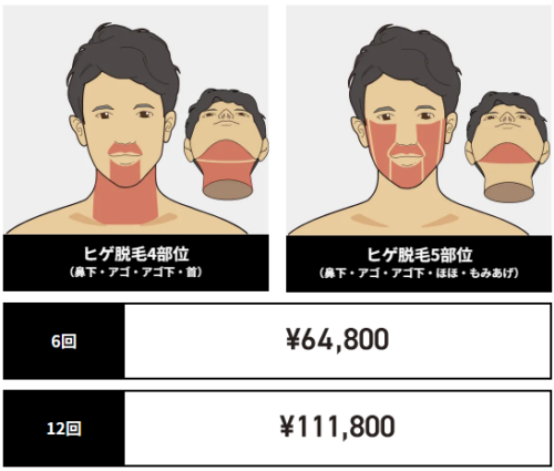 ゴリラクリニックでヒゲ脱毛！何回でツルツルを効果を実感できる？